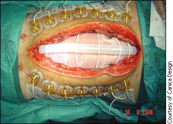 Open abdomen with anchors placed along the incision with elastomers in place ready for the first tensioning